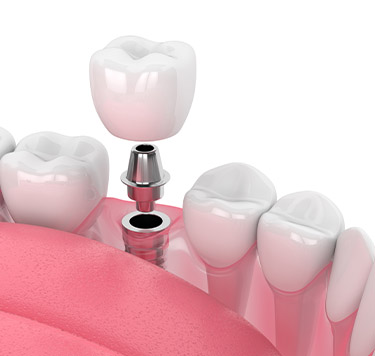 Treatment - Dental Implants