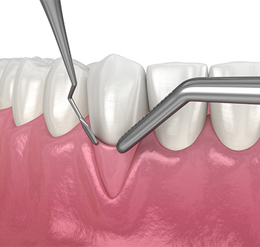 Treatment - Periodontal Treatment