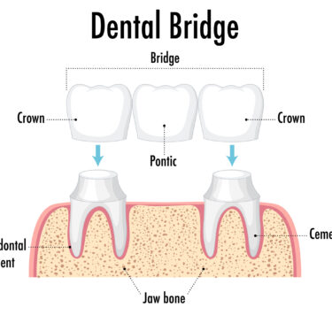 Treatment - Dental Bridges Milton Keynes