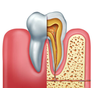 Treatment - Root Canal Treatment